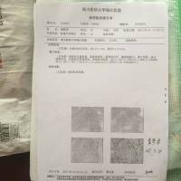 救救我的妻子|患者:虞梦君|疾病:慢性肾脏病((尿