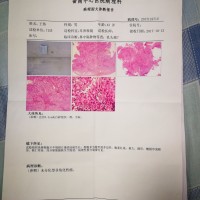 事发突然,求助大家。|患者:王伟|疾病:鼻咽未分