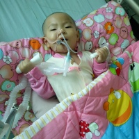 1岁11个月女孩因麻醉意外导致缺血缺氧脑损伤