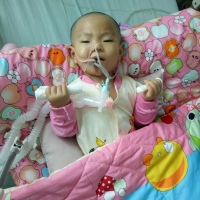 1岁11个月女孩因麻醉意外导致缺血缺氧脑损伤