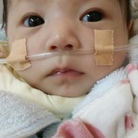 请大家救救我的孩子|患者:邓浙希|疾病:先天性膈