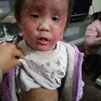 我女儿3岁从2个月开始就患有蚕豆病和严重性