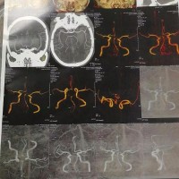 生,却在晚年累倒了!|患者:兰家龙|疾病:脑出血 -水