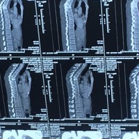 和孩子不能没有你!|患者:王胜|疾病:胸椎结核后