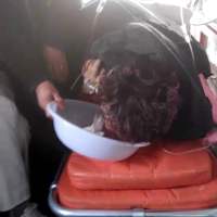 辈子的妈妈|患者:马海珍|疾病:1酒精性肝硬化2主