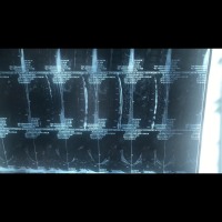 胸椎管多处狭窄,压迫脊髓神经