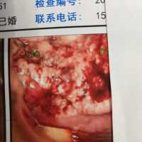 不想让宫颈癌 I B2期夺走我最爱的妈妈。