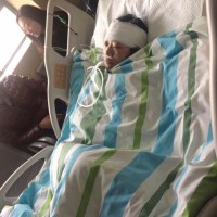 36岁历练第3次脑动脉肿瘤开卢手术的我