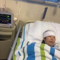 36岁历练第3次脑动脉肿瘤开卢手术的我