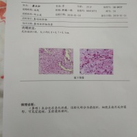 身患中晚期鼻咽癌的我还能够活多久?