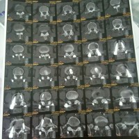 老爸请不要被腰椎骨质增生打倒!这个家还需要