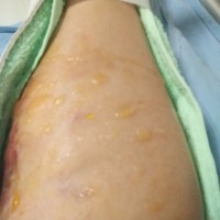 求帮忙求扩散!我想尽快的下地走路!