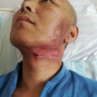 请大家救救口咽癌的我,我想活下去!