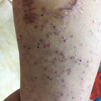 请帮帮我!恶性黑色素瘤,我舍不得抛下家人,求帮