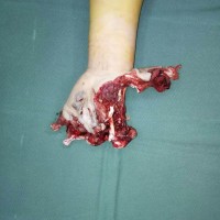 弟弟被鞭炮炸成重伤!希望爱心人士伸出援手!