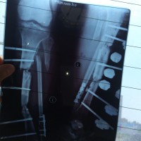 双腿开放性骨折,不能下地走路,还要照顾两个孩