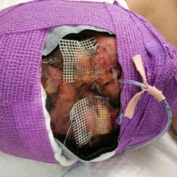 帮帮我烧伤的儿子,让他有个美好的未来!