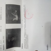 本人帕格玛2016年患肝硬化现申请捐助