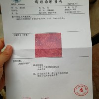 口咽癌,求你不要夺走我的生命!