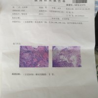 请大家救救舌癌的我,我想活下去!