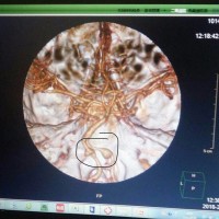 王德民_蛛网膜下腔出血 双侧椎动脉动脉瘤_证