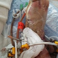 我才一岁九个月,我想好好活着不想截肢!