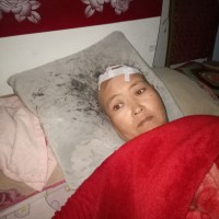 脑瘤压迫神经致使双眼失明,需长期放化疗