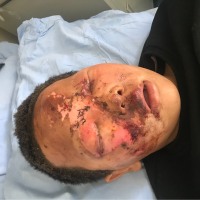 黑龙江省延寿县同安村安福三屯因鞭炮炸伤目前