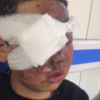 黑龙江省延寿县同安村安福三屯因鞭炮炸伤目前