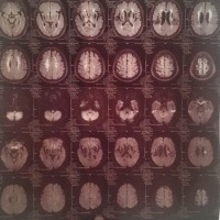 我亲爱的好父亲!因久病脑梗复发!求各位好心人