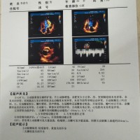 李彦生_心脏瓣膜病,主动脉瓣重度关闭不严,高
