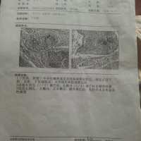 请大家救救宫颈中分化鳞癌的我,我想活下去!