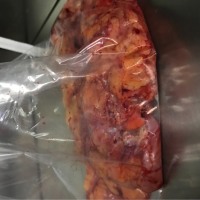 请大家救救结肠癌的我,我想活下去!